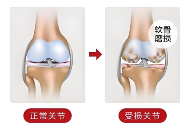 秋季护关节怎么选氨糖?读懂盐酸氨基葡萄糖胶囊和硫酸氨基区别