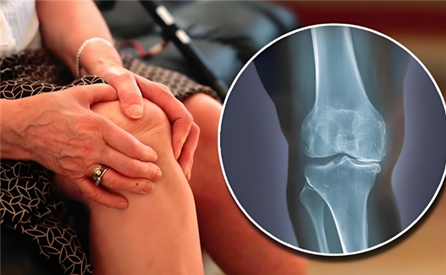 氨糖软骨素钙片能治疗骨关节炎吗？这篇深入讲解！