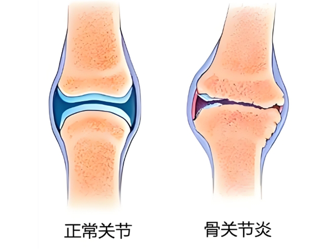 阴雨天关节警报拉响！维固力硫酸氨基葡萄糖胶囊帮助科学应对
