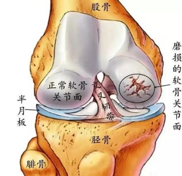 罹患骨关节炎该如何应对？氨基葡萄糖就是可靠帮手