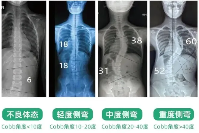 脊柱侧弯复查频率、项目与流程全解析——石家庄直乐医院脊柱侧弯矫正中心复查须知